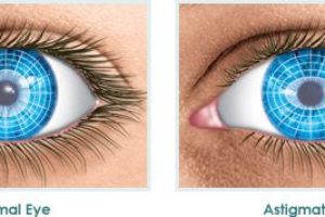 Laser miopia e astigmatismo: sta diventando una mania